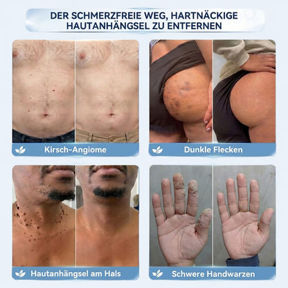 𝐇𝐢𝐬𝐤𝐢𝐧®  2-in-1 Advanced schmerzfreie narbenfreie Hautreparaturcreme – gegen Hautwucherungen, Warzen und sichtbare Hautmakel
