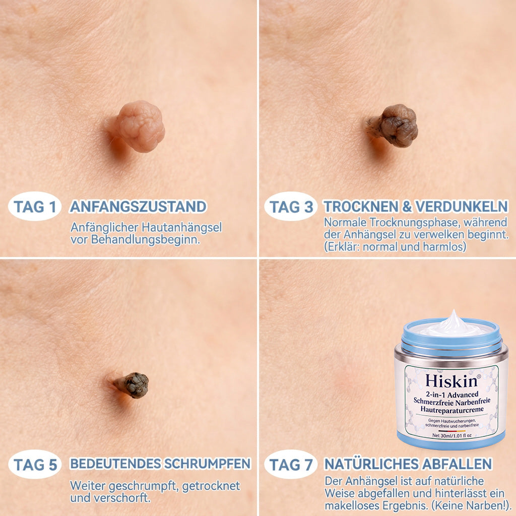 𝐇𝐢𝐬𝐤𝐢𝐧®  2-in-1 Advanced schmerzfreie narbenfreie Hautreparaturcreme – gegen Hautwucherungen, Warzen und sichtbare Hautmakel